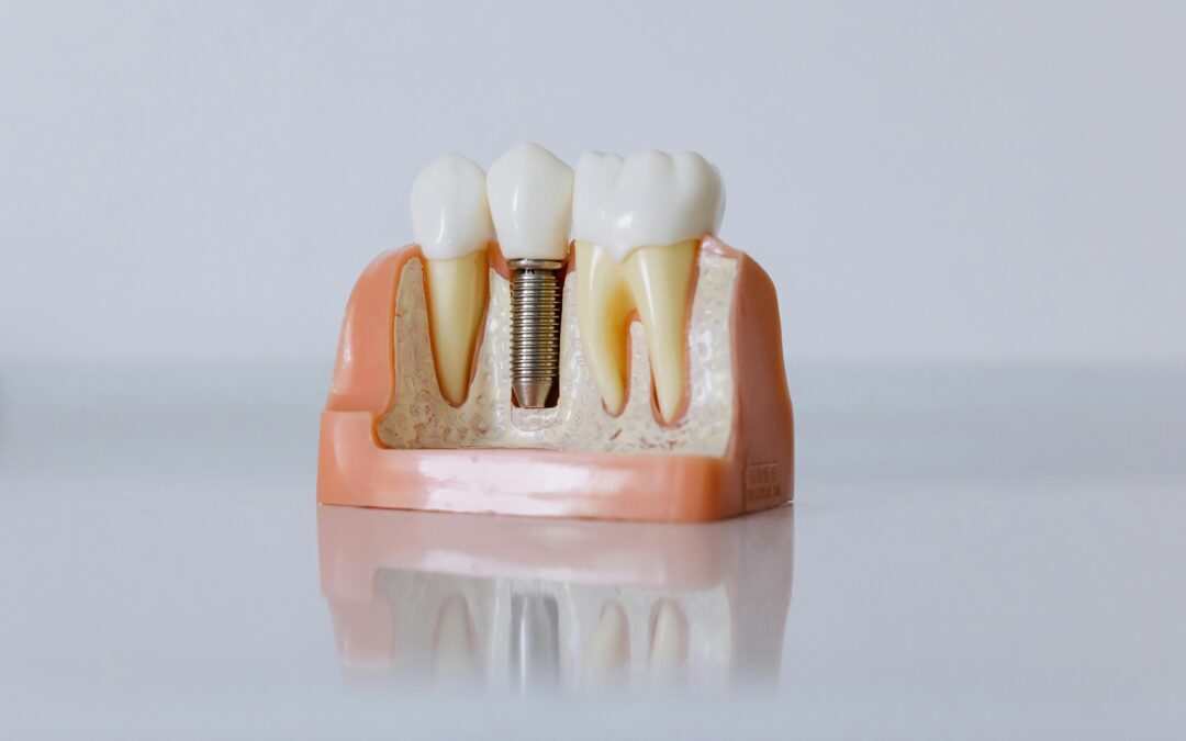 Dental Implants in Agoura Hills – All You Need to Know