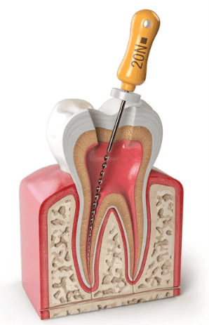 Root Canal Treatment in Agoura Hills: What You Need to Know
