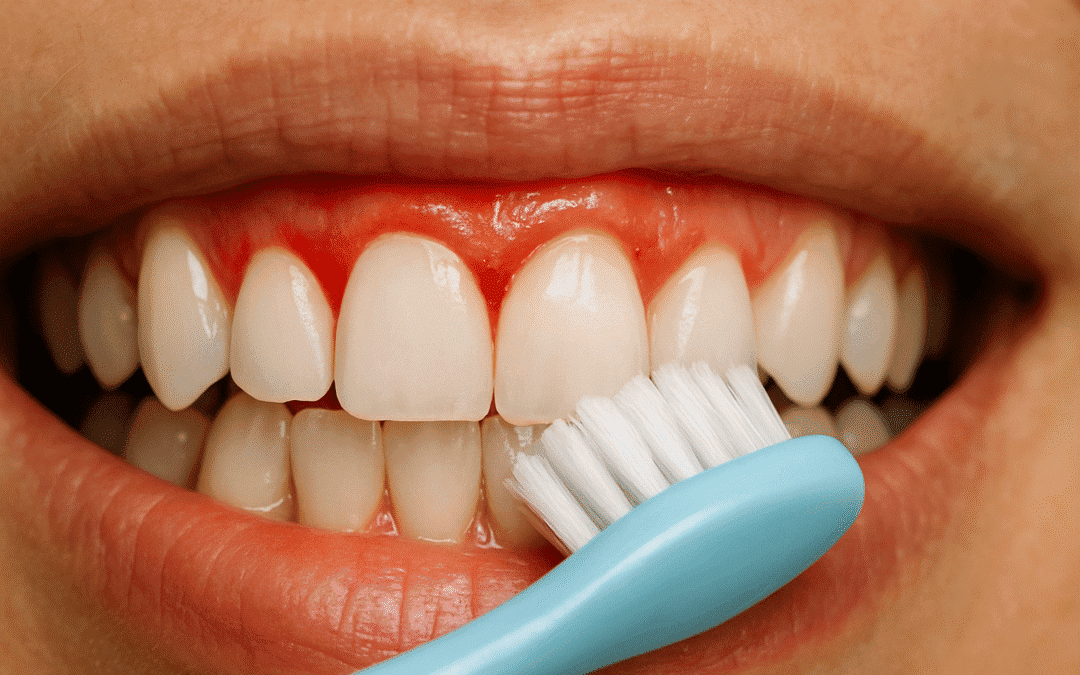 Agoura Hills Dentist – How Much Gum Bleeding Is Normal When Brushing Your Teeth?