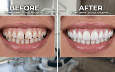 The Cost of Waiting: Why Time is the Most Precious Asset for Your Smile (and Your Confidence)