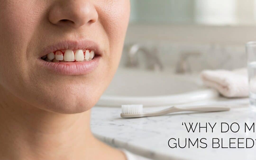 The Silent Smile Killer: Why Your Gums Bleed (And How to Stop It Fast)