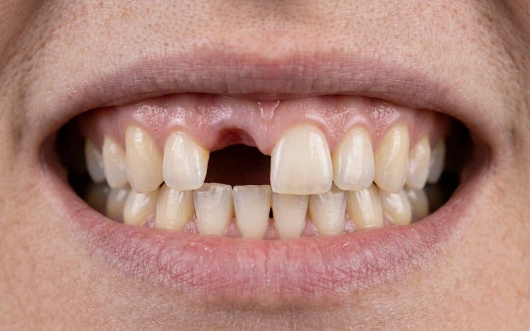 The Hidden Impact of Missing Teeth on Your Jaw, Bite, and Overall Health