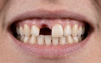 The Hidden Impact of Missing Teeth on Your Jaw, Bite, and Overall Health